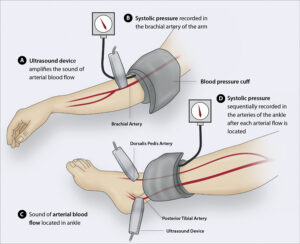 Are you at high risk for Peripheral Artery Disease (PAD)?Peripheral Artery Disease
