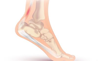 Learn About Achilles Tendonitis & How We Can Help