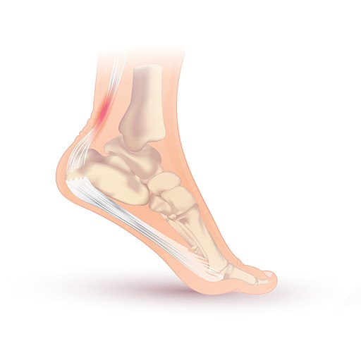 Achilles Tendonitis example of inflamed tendon