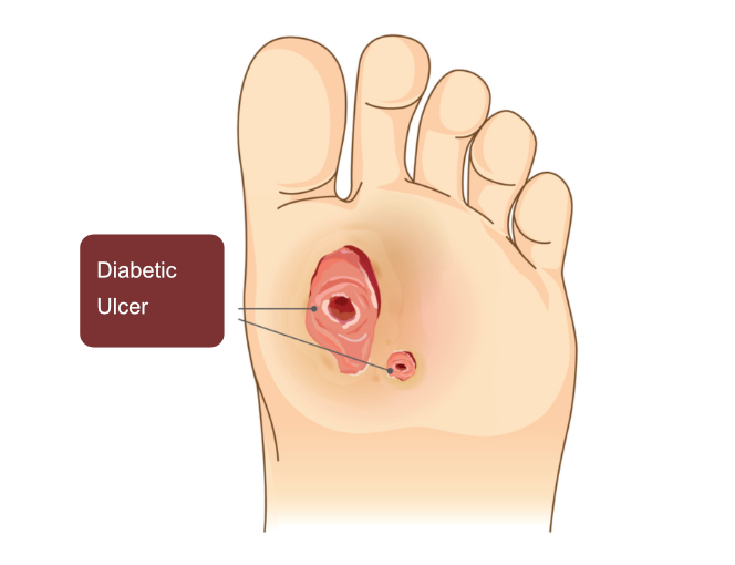 Diabetic Ulcer – What you need to know to avoid dire consequences…